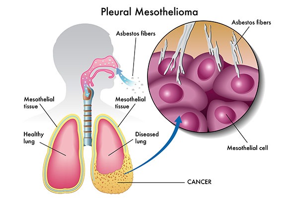 Mesothelioma Cancer | Asbestos Exposure | MoldPro | Alberta Asbestos and Mold Removal Specialists